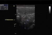 vergrößerte Nebennieren des betroffenen Hundes